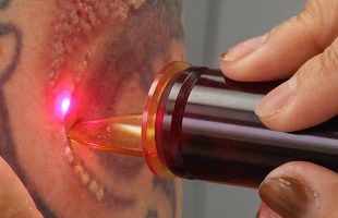 Looking After Your Skin After Laser Removal Treatment